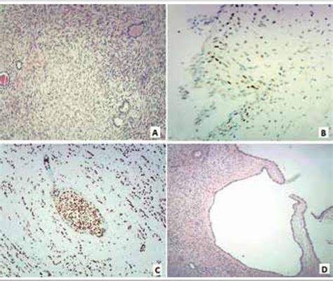 SciELO Brasil Renal Mixed Epithelial And Stromal Tumor Case Report