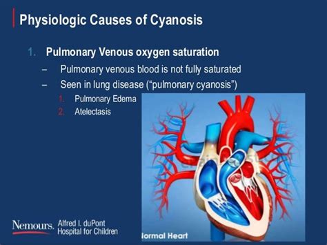 Approach to cyanotic chd