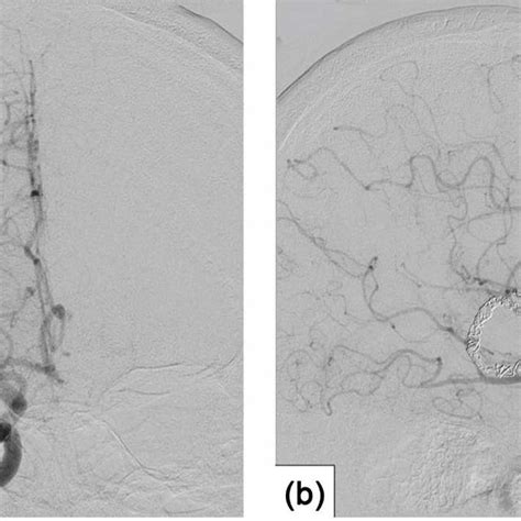 Six Month Follow Up Angiogram A Frontal View B Lateral View Show