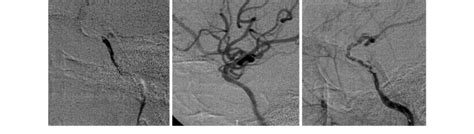 Left Left Carotid Angiogram Obtained 7 Days After The First Stenting