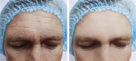 Male Forehead Wrinkles before and after Biorevitalization Cosmetology Treatment Stock Photo ...