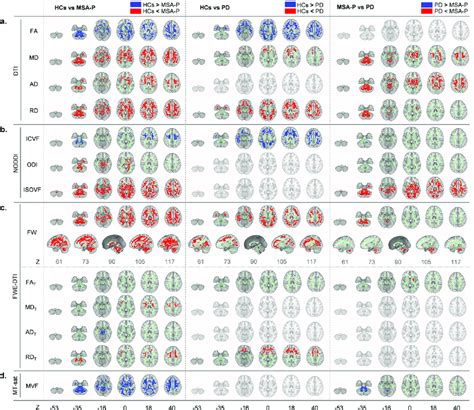 Comparison Of Dti Noddi Fwe Dti And Mt Sat Diffusion Tensor Imaging