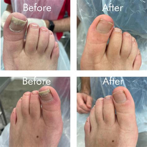 Toenail Fungus Laser Treatment Podiatrists Eastern Suburbs Sydney