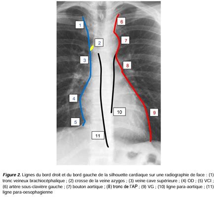 Insuffisance Cardiaque Et Valvulopathies Cartes Quizlet