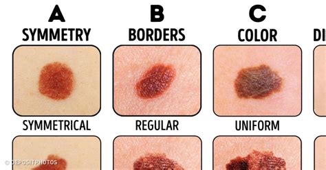 How To Get Rid Of Birthmarks Fast At Home Arvigy