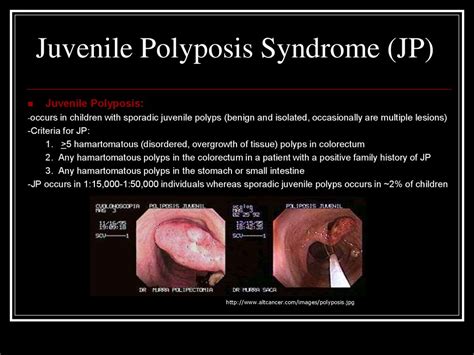 Polyposis Syndrome