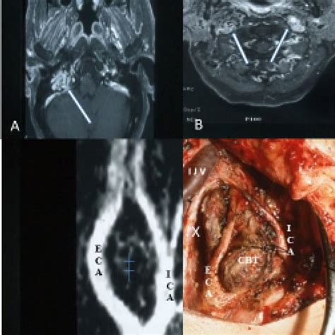 Paraganglionic tissue locations in the head and neck. Sara Yang, MD... | Download Scientific Diagram