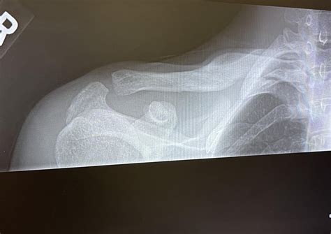 My broken clavicle : r/XRayPorn