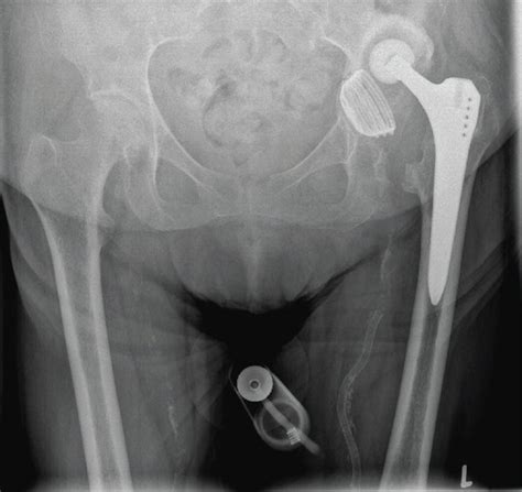 The Pelvic Radiographs Demonstrate Dislocation Of Left Total Hip