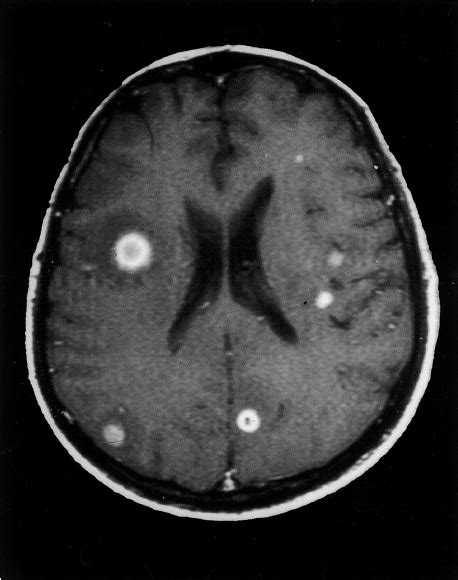 Axial Contrast Enhanced T Weighted Mri Image Of The Brain Months