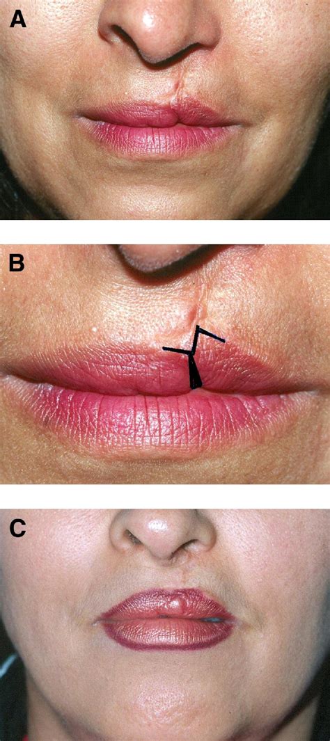 Creative Uses Of The Z Plasty Technique Operative Techniques In