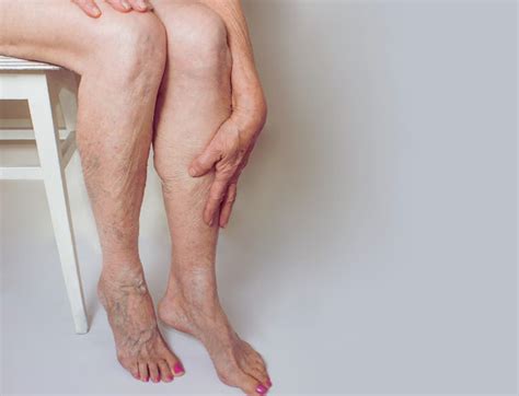 Why You Should Not Ignore Your Varicose Veins Vein Solutions