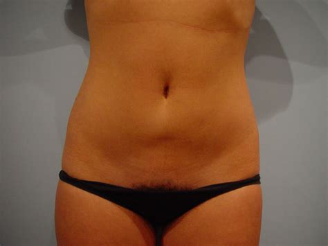 Liposuzione Liposcultura Chirurgia Estetica Pisa Dott Cecchini