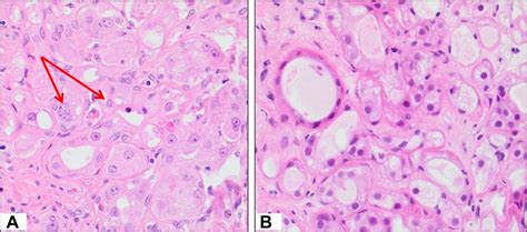 Apocrine Lesions Of The Breast Part 1 Of A Two Part Review Benign Atypical And In Situ