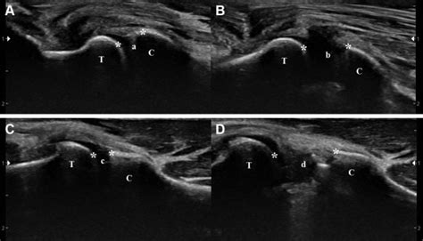 Valgus Stress Ultrasound For Medial Ulnar Collateral Ligament Injuries In Athletes Is