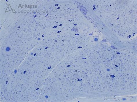 Neuropathy Associated with Amyloid - Arkana Laboratories