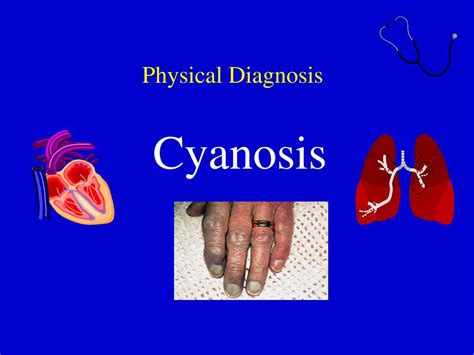 PPT - Physical Diagnosis Cyanosis PowerPoint Presentation, free ...