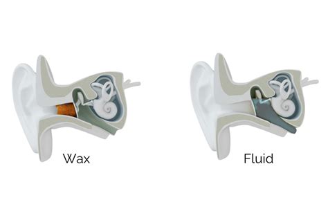 What Are The Different Levels Of Hearing Loss That People Experience Novus Health