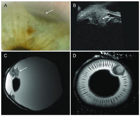 Ciliary Body Melanoma A Photograph Iris With Visible Melanoma At