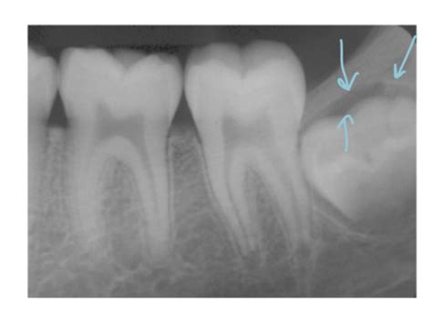 Intraoral Radiographic Anatomy Mandible Flashcards Quizlet