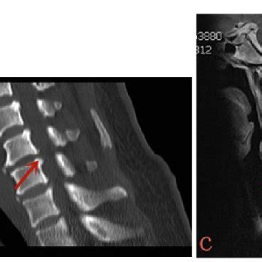 Postoperative CT showing that the disc-osteophyte complex had been... | Download Scientific Diagram