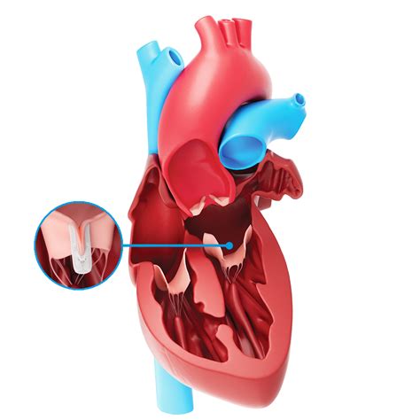 Mitral Valve Repair | Mitral Regurgitation