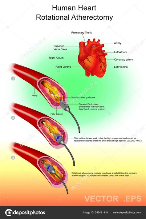 Atherectomy Procedure Which Performed Remove Atherosclerotic Plaque