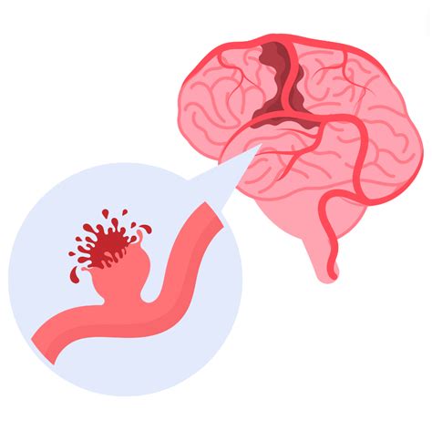 Brain Aneurysm Glossary And Terms Supreme Vascular And Interventional Clinic