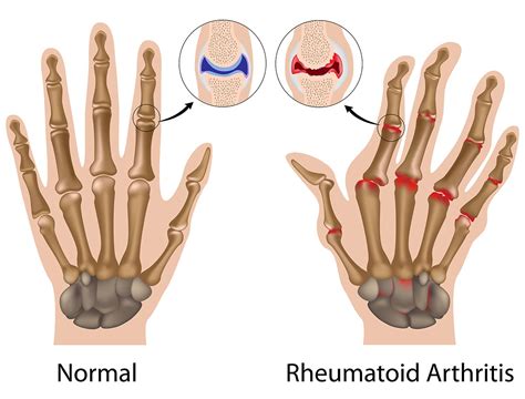 Symptoms And Causes For Rheumatoid Arthritis Vejthani