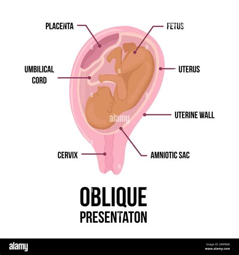 Umbilical Cord Diagram