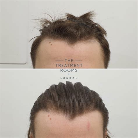 Small temple hair transplant- 600 grafts