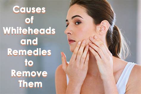 Causes Of Whiteheads And Remedies To Remove Them