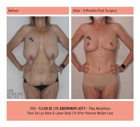 Fleur De Lys Abdominoplasty Dr Jeremy Hunt