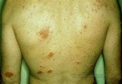 Nummular Dermatitis Pictures Causes Treatment Symptoms Causes Treatment And Prevention Of