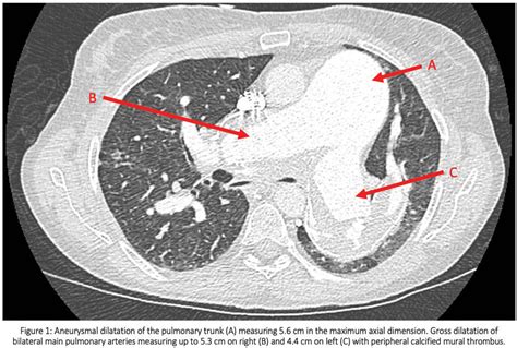 A RARE CASE OF AGGRESSIVE CHRONIC THROMBOEMBOLIC PULMONARY HYPERTENSION