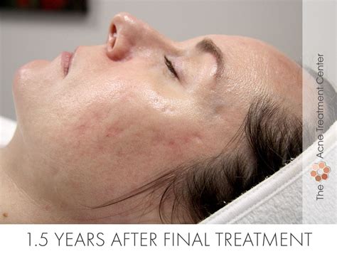 Rolling Acne Scar Treatment Acne Treatment Center Portland OR