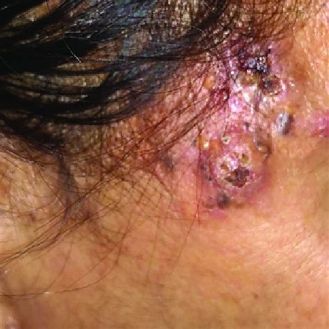 Poorly Defined Scarring Alopecia Plaques Studded With Yellowish