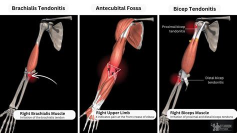 Distal Bicep Tendonitis Treatment Managing Lower Bicep Pain