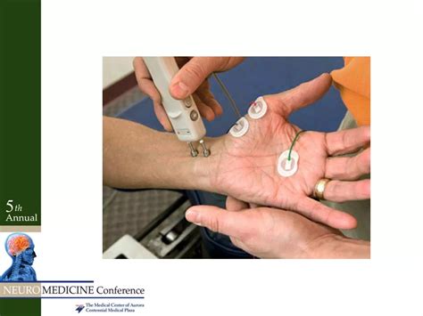 Radiculopathy vs peripheral neuropathy | PDF