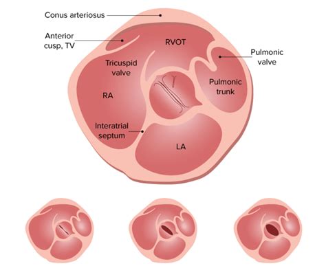 Estenosis Aórtica Concise Medical Knowledge