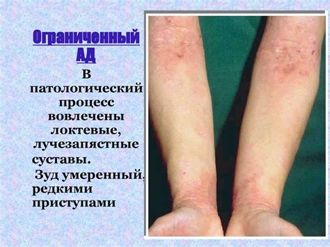 Атопический дерматит - презентация онлайн
