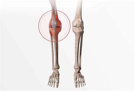 Définition symptômes et diagnostic de la fracture du genou Dr Paillard