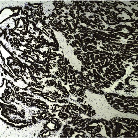 Hande Stain Of Papillary Cystadenoma Of The Epididymis Epididymal Duct Download Scientific