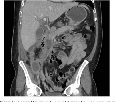 Figure 1 from An unusual case of pancreatic fistula | Semantic Scholar