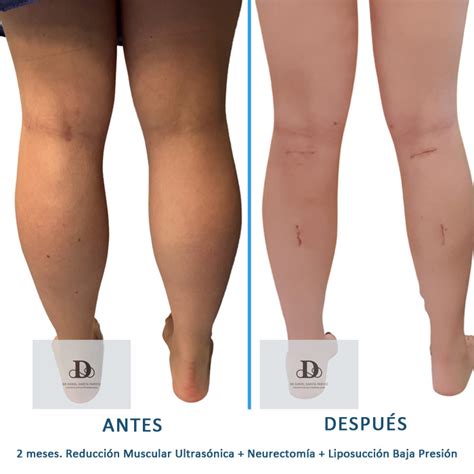 Antes y Después Reducción de Piernas