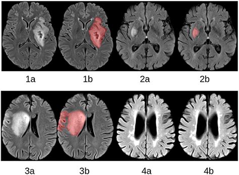 Frontiers Stroke Lesion Segmentation In Flair Mri Datasets Using