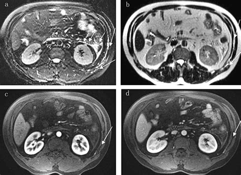 Mr Imaging Of Acute Pancreatitis Correlation Of Abdominal Wall Edema With Severity Scores