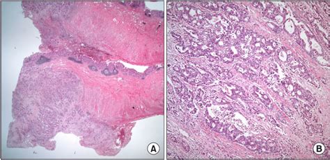 Gross And Microscopic Findings Of The Surgical Specimen A The