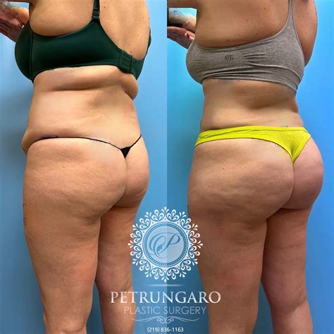 Tummy Tuck Lipo 360 Brazilian Butt Lift Renuvion Petrungaro