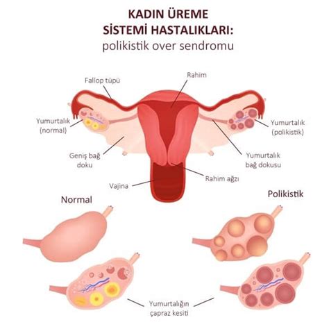 Polikistik Over Sendromu PCOS Belirtileri Nedenleri Ve Tedavisi